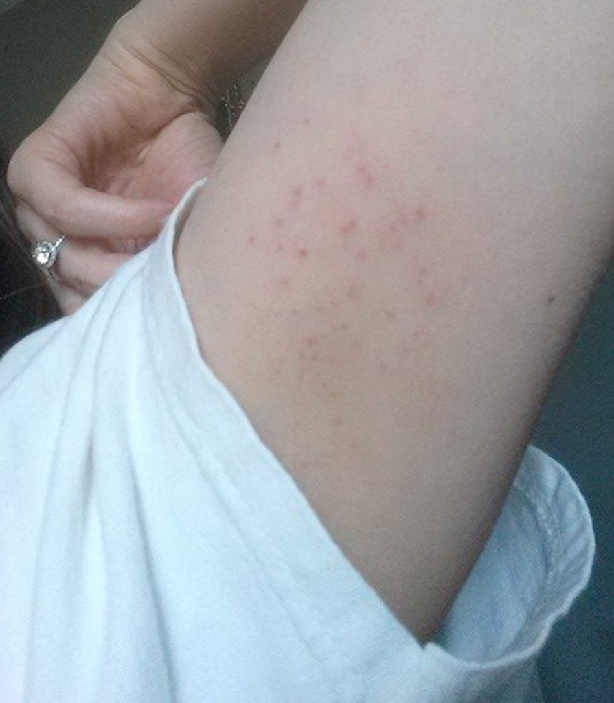 eczema