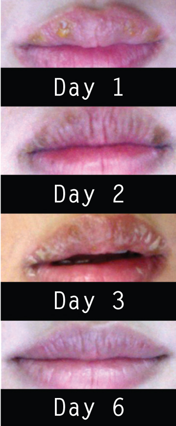 LipHealing-PatientSelfies-SkintelArticle-SepNov2013InSKIN